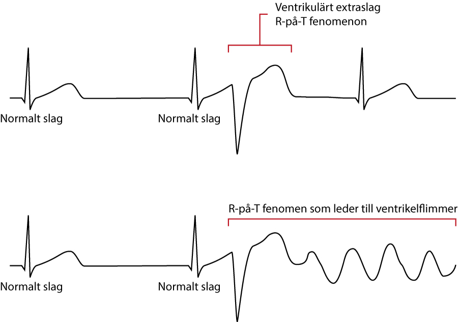 Figur 6B. R-på-T fenomen