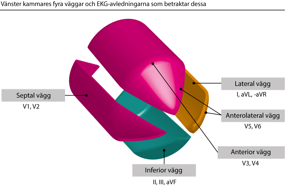 Vänster kammares form påminner om en pistolkula. Kammaren kan delas in i fyra väggar och figuren visar EKG-avledningarna som betraktar respektive vägg.