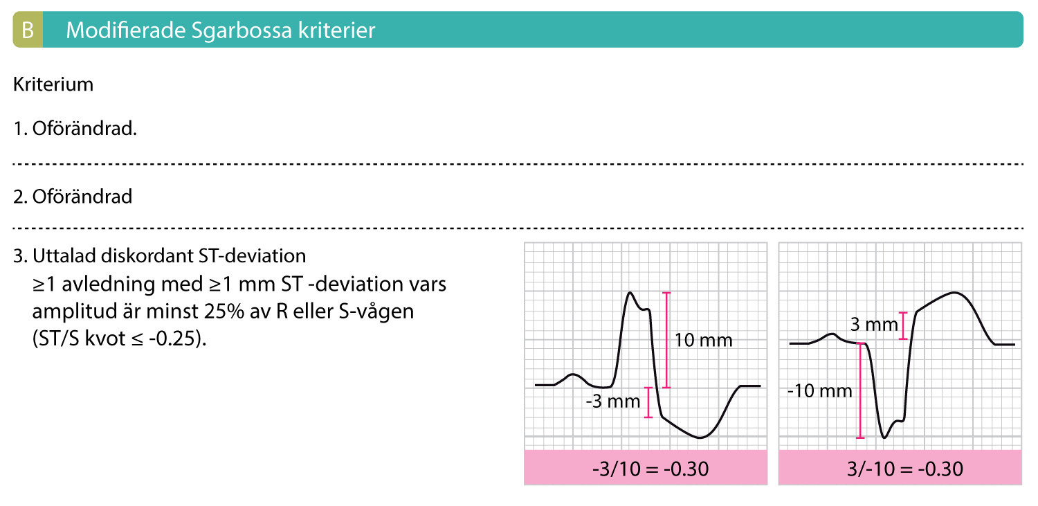 Figur 1B. Modifierade Sgarbossa kriterier innebär att det tredje kriteriet ersätts med ett kriterium där ST-deviationens amplitud ställs i relation till QRS-komplexets amplitud.