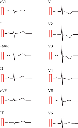 EKG PATHOLOGIEN RD visual data 3