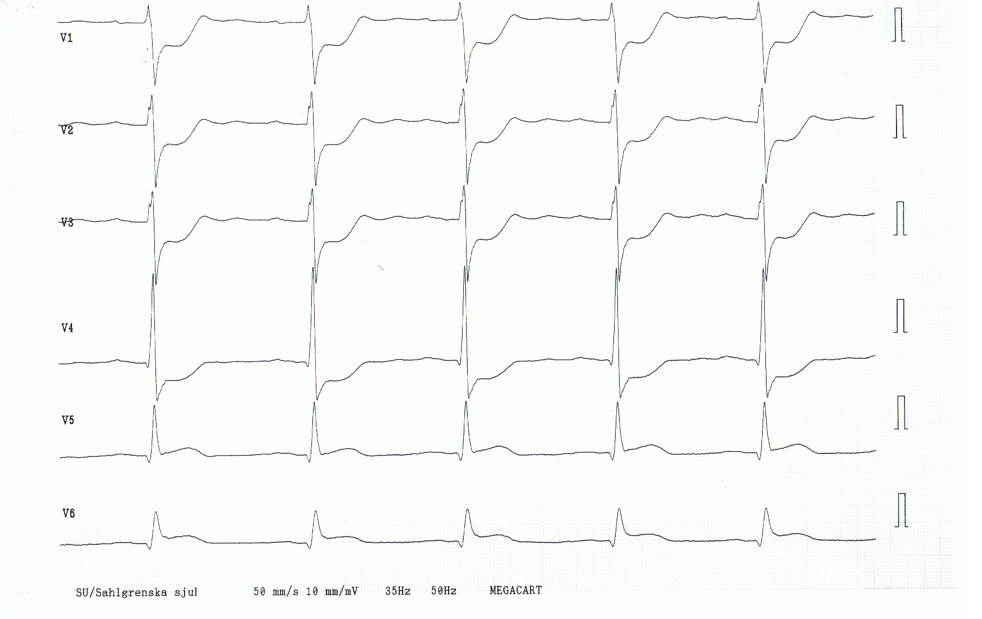 x_stemi2