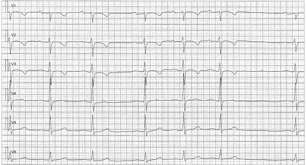 Is Borderline ECG Dangerous? Understanding Your ECG Reports