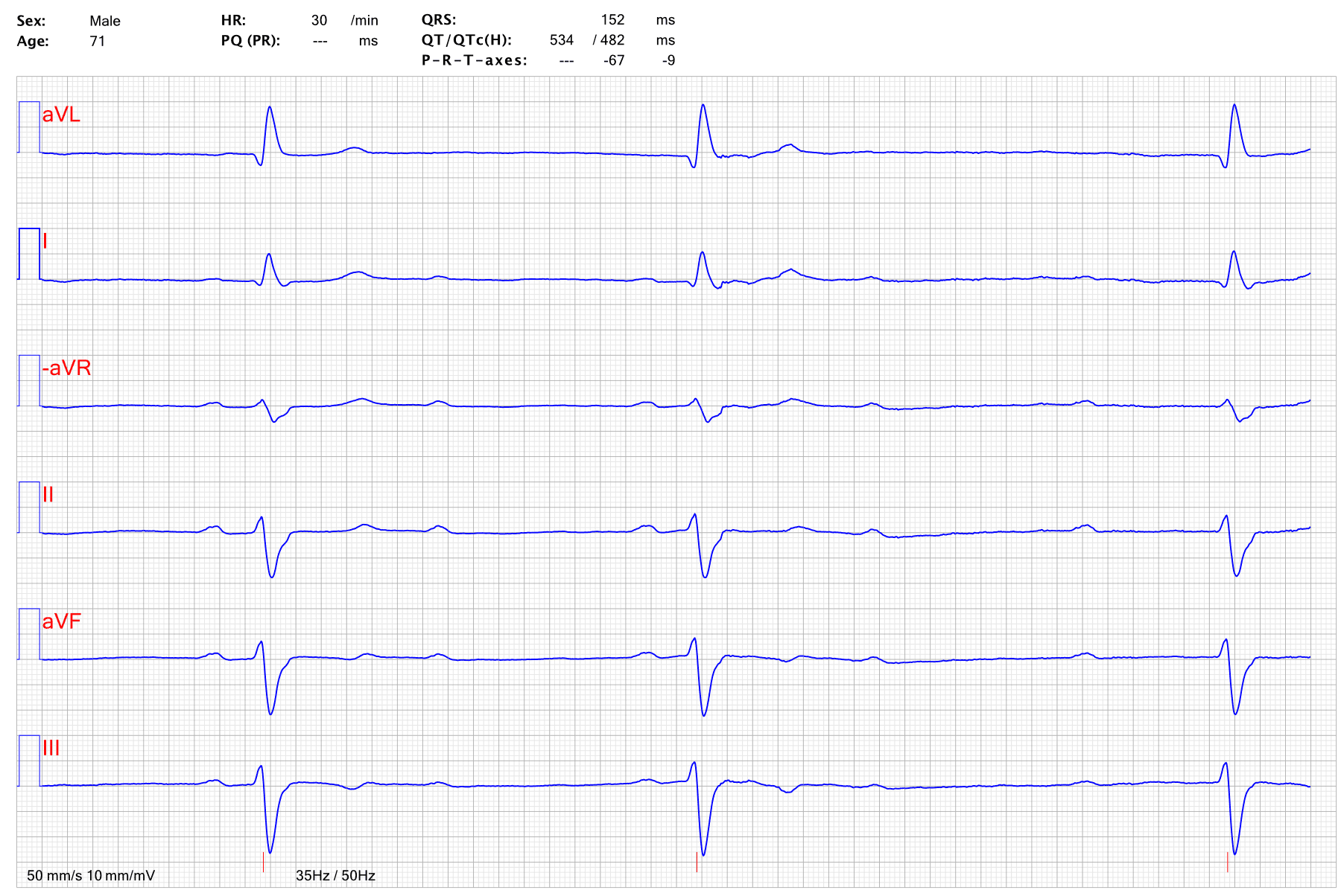 Illustration ur kursen EKG-boken