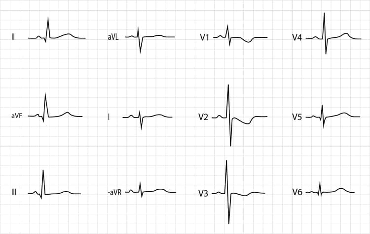Figur 1. Normalt EKG 8 dagar gammal flicka. Notera att el-axeln är högerförskjuten (negativt QRS i avledning I och positivt QRS i avledning II). R-vågorna är höga i V1–V3, där också negativa T-vågor ses. Det ses Q-vågor infernot (II, aVF, III) och lateralt (V5, V6). Detta är ett helt normalt EKG för barnets ålder.