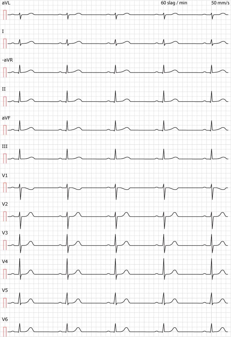 Figur 38. Sinusrytm. Normalt EKG i övrigt.