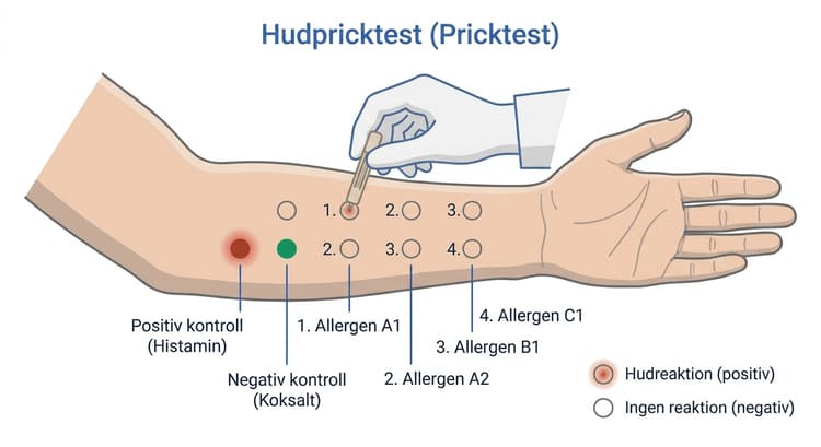 Pricktest med flera testställen markerade på underarmen