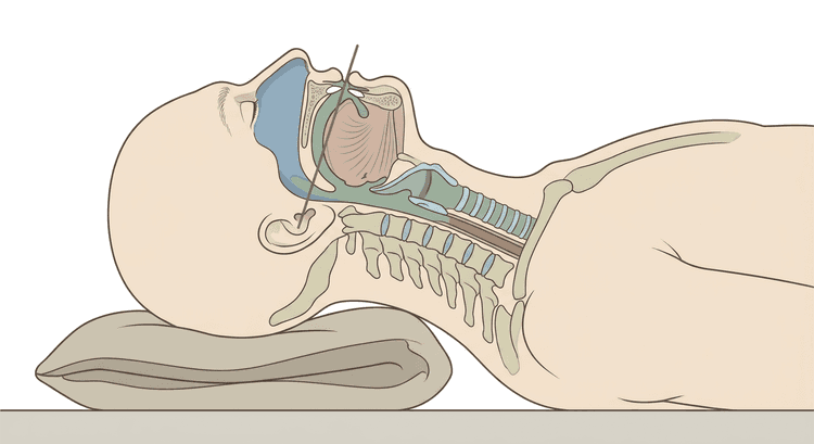 Patient i sniffing position inför endotrakeal intubation