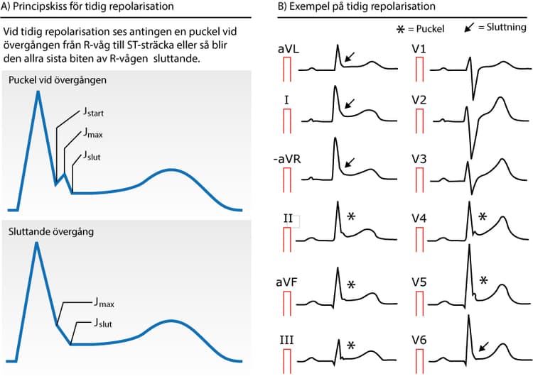 Figur 75. Early repolarization (tidig repolarisation).