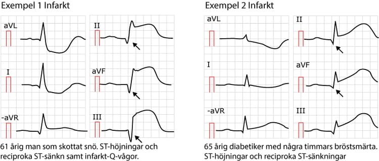 Exempel på ST-höjningsinfarkter (STEMI/STE-AKS). Notera att i båda dessa fall finns faktiskt patologiska Q-vågor (pilar), vilket antingen är gamla infarkter eller så har detta EKG registrerats flera timmar efter symptomdebuten.