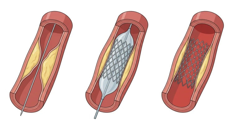 Tre uppskurna kranskärlssegment som visar stenos med ledare, uppblåst ballong med stent och kvarliggande expanderad stent.