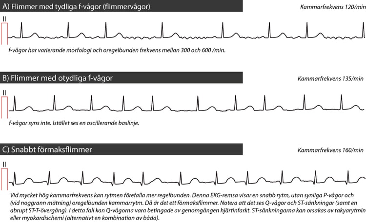 Figur 43. Förmaksflimmer.
