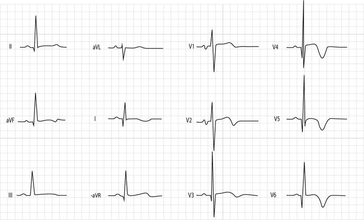Figure X. Pojke 17 år med hypertrof obstruktiv kardiomyopati. Notera även P-mitrale.