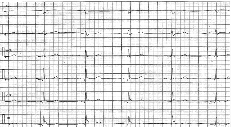 EKG med extremitetsavledningarna i ordningen aVL, I, −aVR, II, aVF och III. Långsam kammarfrekvens och en positiv deflektion direkt efter QRS-komplexet, tydligast i II, aVF och III.