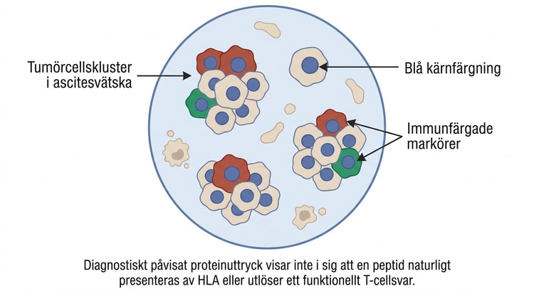 Mikroskopisk bild av tumörcellskluster i ascitesvätska med blå kärnfärgning och röda och gröna tumörmarkörer.