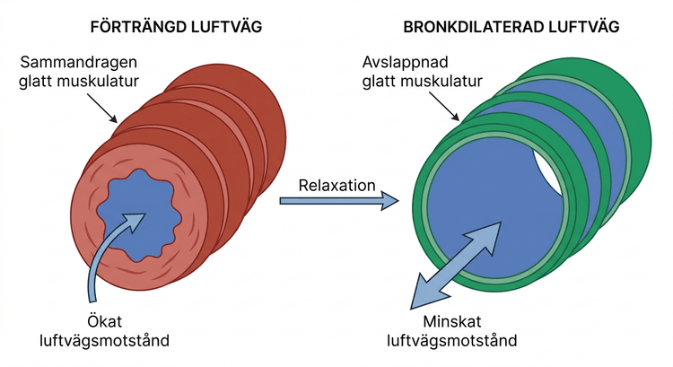 Schematisk jämförelse mellan förträngd och bronkdilaterad luftväg
