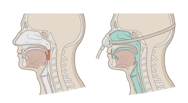 Två sagittalsnitt av huvud och hals. Till vänster är svalget stängt bakom mjuka gommen och tungbasen vid obstruktiv sömnapné, till höger håller trycket från en nasal CPAP-mask hela luftvägen öppen från näsan till luftstrupen.