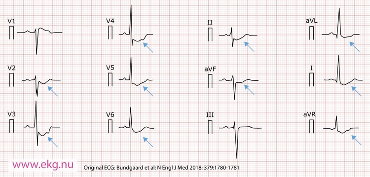 Figur 1. 12-avlednings-EKG från manlig patient, 63 år gammal, med konkava (uppåt) ST-sänkningar i avledning I, II, aVL, aVF, -aVR och V2 till V6. Det ses också ett hack i den uppåtgående delen av ST-sträckan.