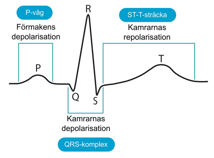 Figur 4. Den klassiska EKG-kurvan och de händelser som avspeglas. På denna registrering ses ett kammarkomplex som består av Q-, R- och S-våg (men en eller flera av dessa kan saknas under normala förhållanden).