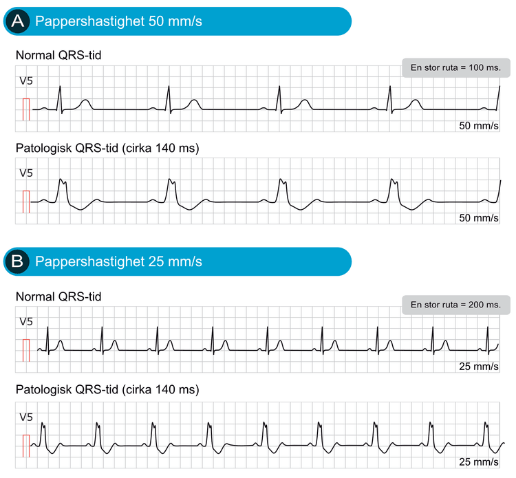 Figur 7. Exempel på normala och breda QRS-komplex med två olika pappershastigheter. Detta är exakt samma EKG-remsa med två olika pappershastigheter. I Sveriges används 50 mm/s vid bedömning av vilo-EKG. Hastigheten 25 mm/s är vanlig i sammanhang då bedömningar av hjärtrytm görs.