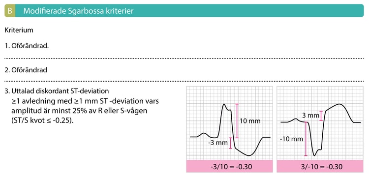 Figure 1B. Modifierade Sgarbossa kriterier innebär att det tredje kriteriet ersätts med ett kriterium där ST-deviationens amplitud ställs i relation till QRS-komplexets amplitud. 
