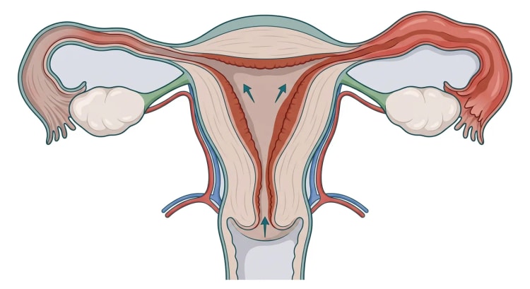 Frontalsnitt av livmoder, cervix, äggledare och äggstockar där rödbrun inflammerad slemhinna sträcker sig från cervikalkanalen genom livmoderhålan till båda äggledarna, med pilar som visar uppåtgående spridning.