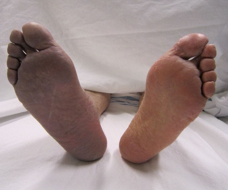 Foto av en patients båda fotsulor sedda från fotändan av sängen. Höger fotsula, till vänster i bilden, är blåviolett och blek, medan vänster fotsula har normal hudfärg.
