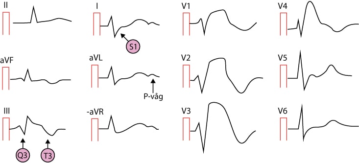 EKG med lungemboli (S1Q3T3-mönster)