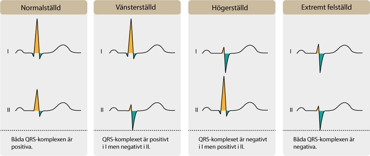 Figur 18. Bestämning av el-axel med hjälp av QRS-areal i avledning I och II.