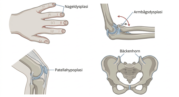 Illustration av nagel-, armbågs-, patella- och bäckenförändringar vid nagel–patella-syndrom.