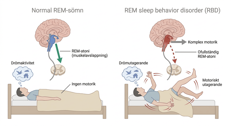 Illustration av motoriskt utagerande vid REM sleep behavior disorder