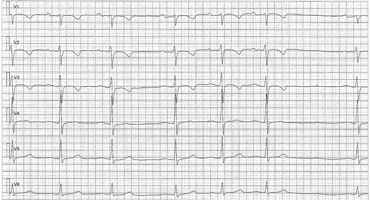 Figure 2. Sinusarytmi med sinuspaus. Negativa T-vågor är normalt i V1–V3 (patienten var 15 år gammal när EKG registrerades).