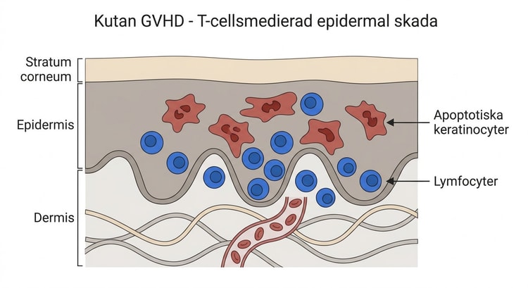 Histologiskt preparat av hud med apoptotiska keratinocyter och omgivande lymfocyter vid graft-versus-host-sjukdom.