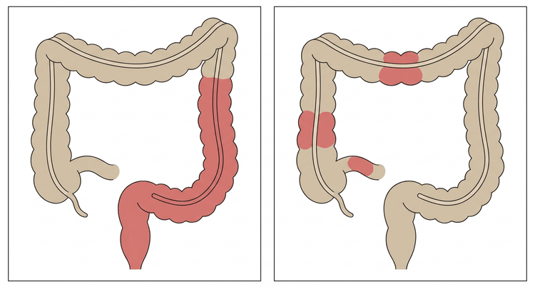 Två paneler med samma översikt av tjocktarmen där den vänstra visar sammanhängande inflammation från rektum och uppåt genom sigmoideum och nedåtgående colon, medan den högra visar fläckvis inflammation i terminala ileum, uppåtgående och tvärgående colon med friska avsnitt emellan
