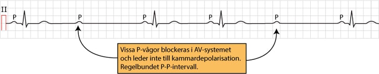 Figur 96. AV-block II Mobitz typ II.