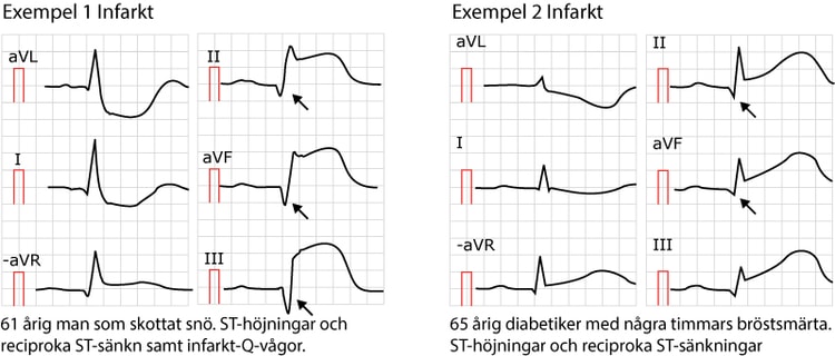 Exempel på patologiska Q-vågor. Två patientfall med inferior ST-höjningsinfarkt där patienterna redan vid ankomst uppvisade inferior Q-vågsutveckling.