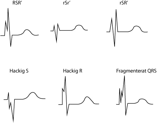 Figur 88. Fragmenterat QRS-komplex.