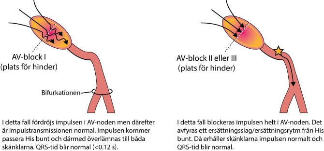 Figur 93. Lokalisering av hindrets nivå vid AV-block.