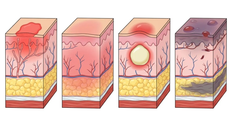 Fyra tvärsnitt av hud och mjukdelar sida vid sida som visar erysipelas, cellulit, abscess och nekrotiserande fasciit.