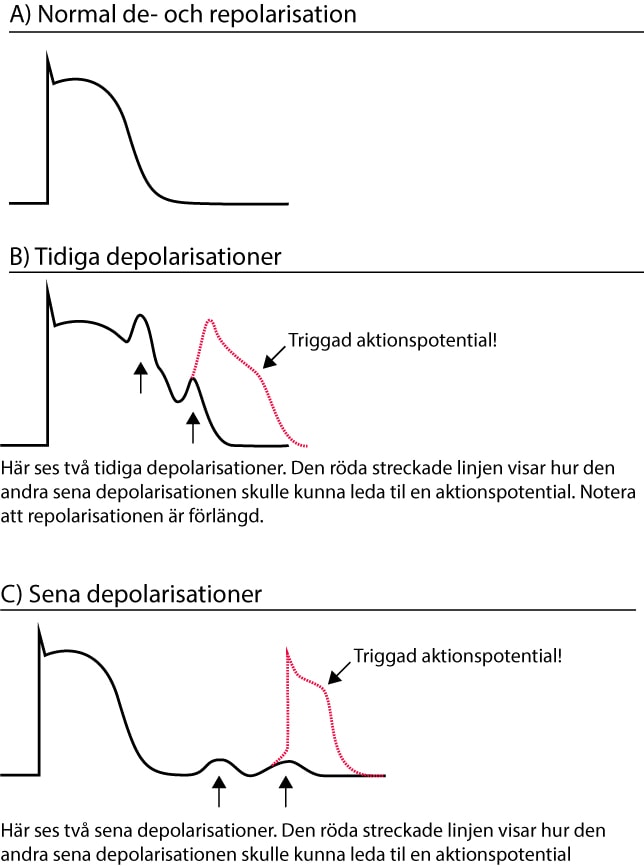 Efterdepolarisationer som leder till triggade aktionspotentialer.