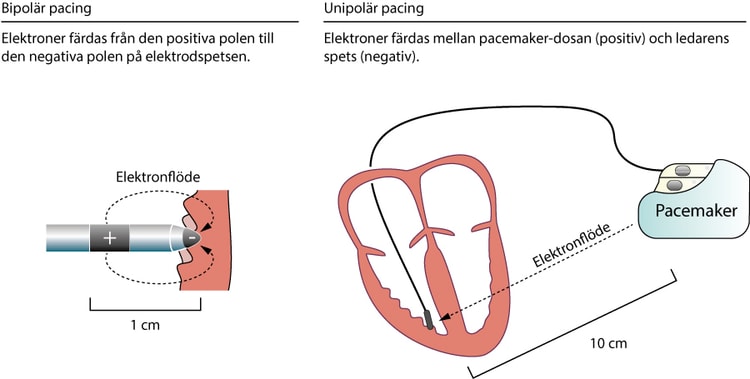 Pacemaker