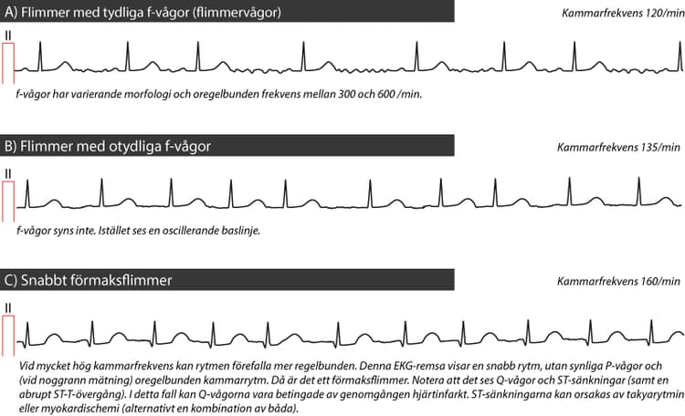 Figur 43. Förmaksflimmer.