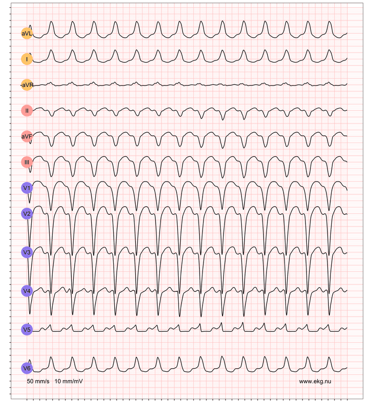 EKG exempel 1. Patient med WPW-syndrom (pre-excitation med takyarytmier). Patienten har en känd WPW och detta EKG registreras under en pågående supraventrikulära takyarytmi.
