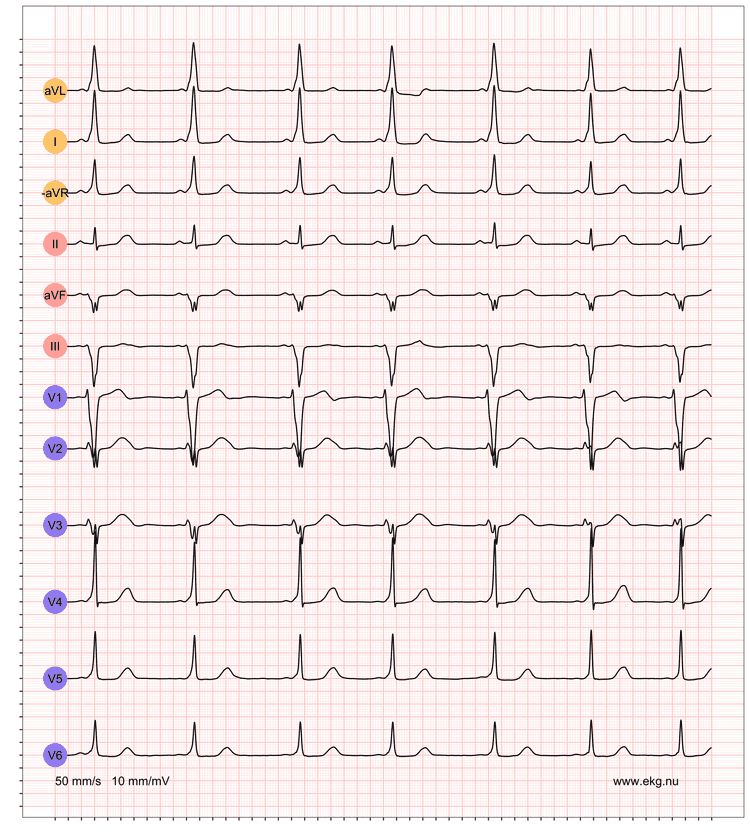 EKG exempel 2. Patient med pre-excitation på vilo-EKG.