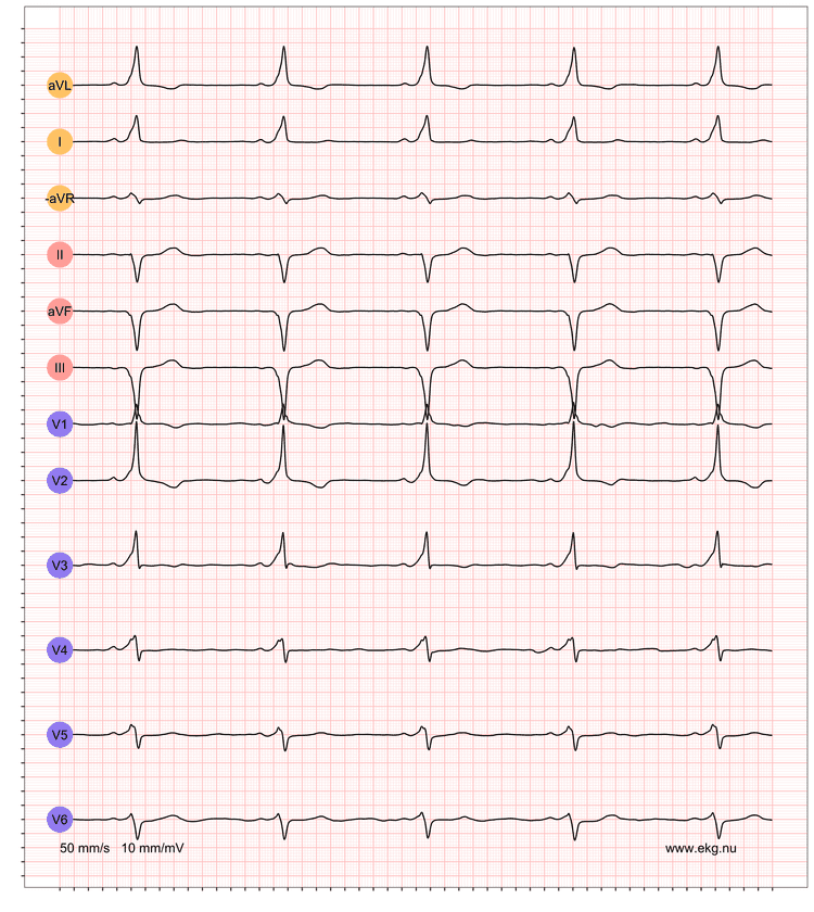 EKG exempel 3. Patient med pre-excitation på vilo-EKG.