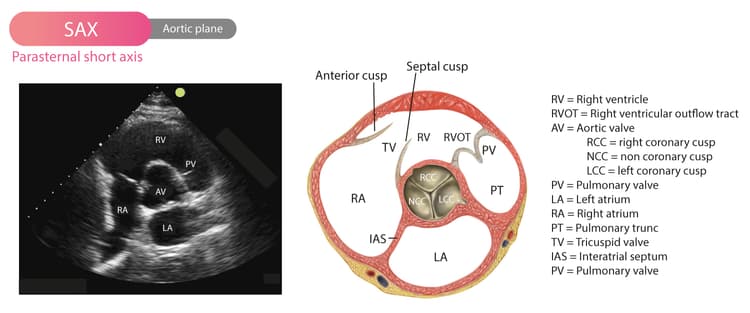 Aortaklaffen visualiserad i PSAX (parasternal kortaxelvy)