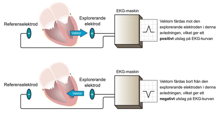 Figur 6. Varje EKG-kurva representerar en avledning. Minst två elektroder ingår i en avledning eftersom det behövs en explorerande elektrod samt en referens.