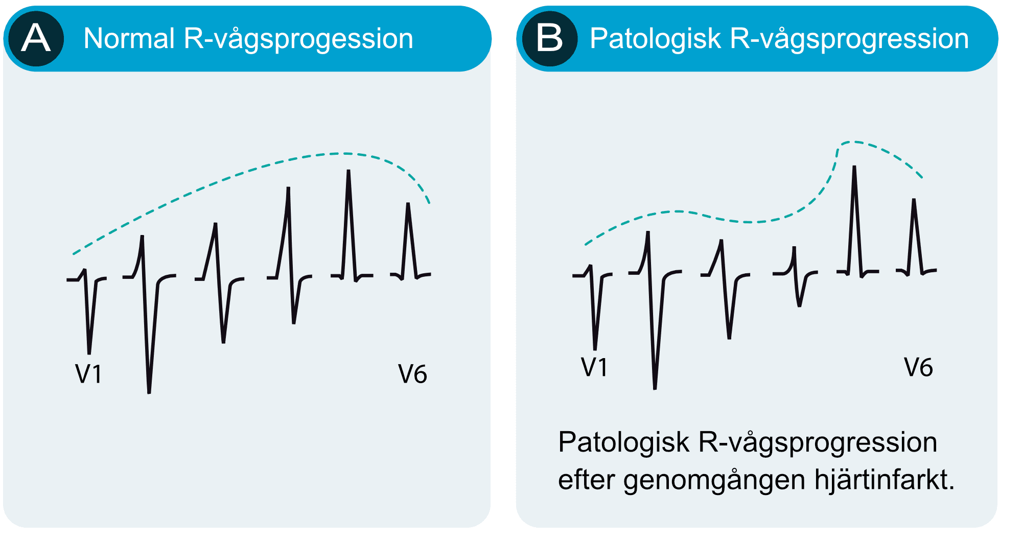 Normal och patologisk R-vågsprogression i bröstavledningarna V1 till V6.