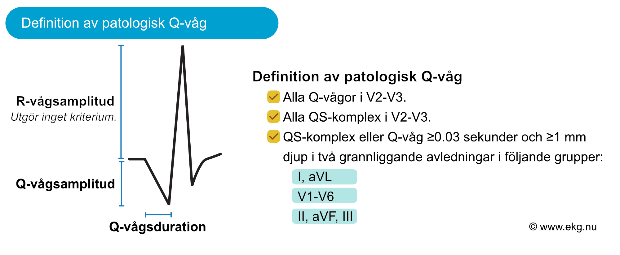 Definition av patologiska Q-vågor på EKG enligt kriterier från ESC.