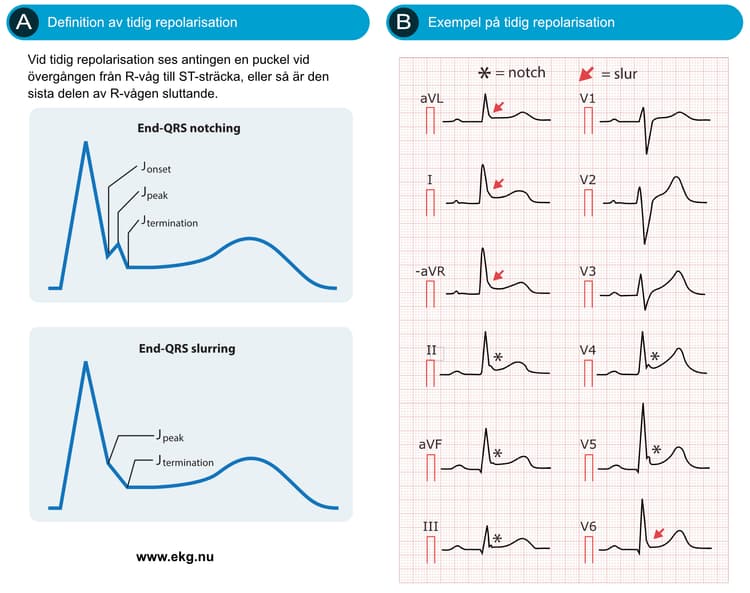 Figur 75. Early repolarization (tidig repolarisation). Efter MacFarlane et al.