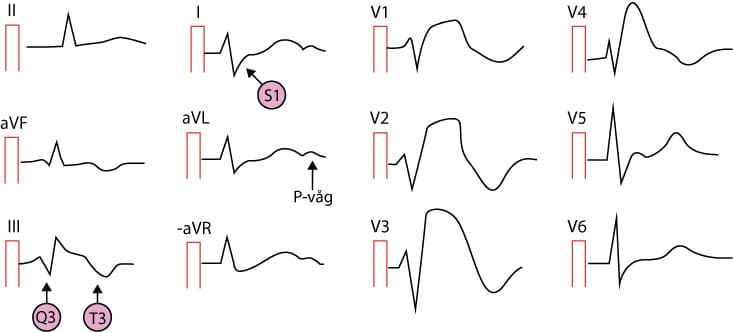 EKG med lungemboli (S1Q3T3-mönster)